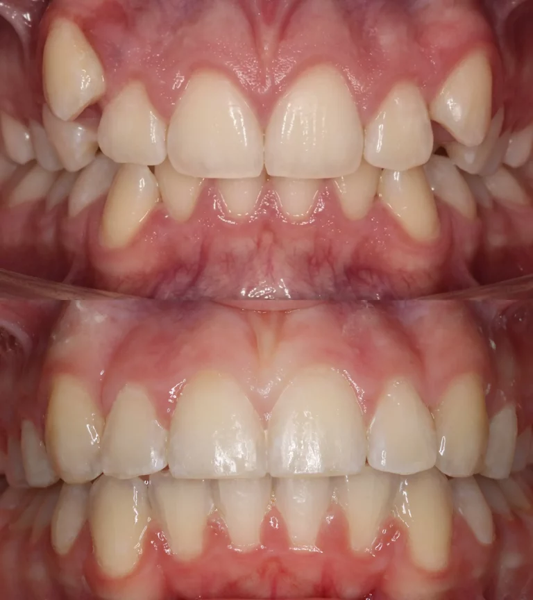 vorher-nachher-frontal-kieferorthopaedie